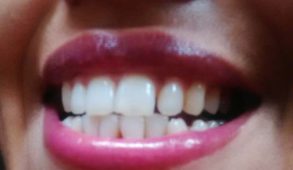 मसूड़ों के रोग से हैं परेशान तो आजमाएं ये नुस्खे....